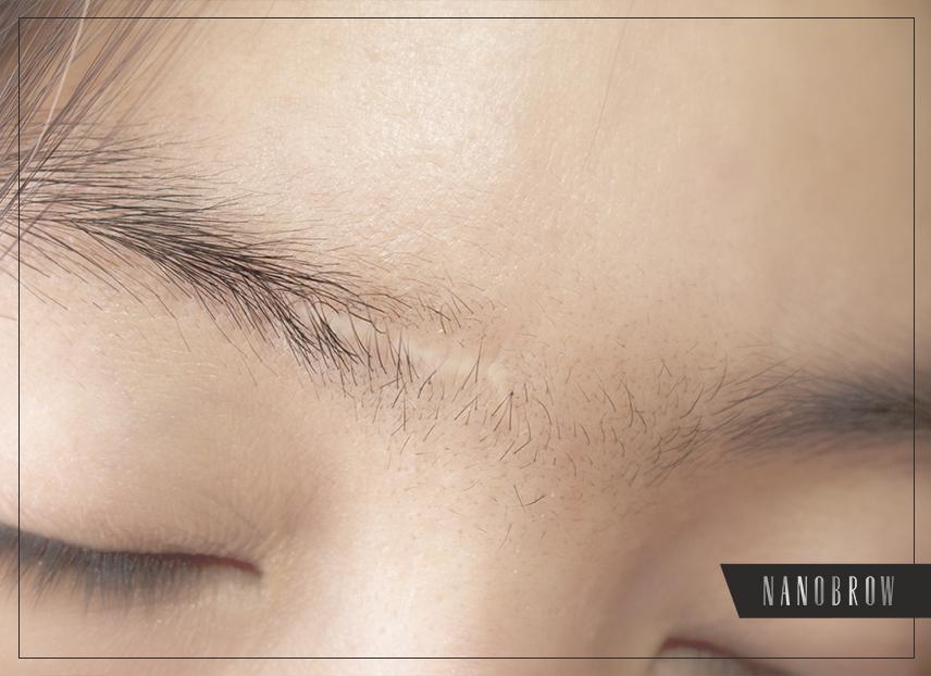 Wie man Augenbrauen Narben loswird